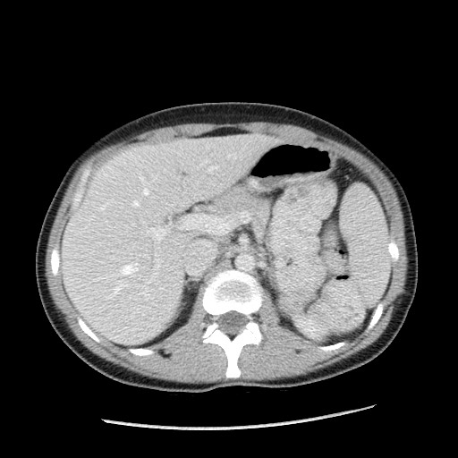 Castleman disease with fibrous pseudotumor in the abdomen (Radiopaedia 77296-89373 A 36).jpg