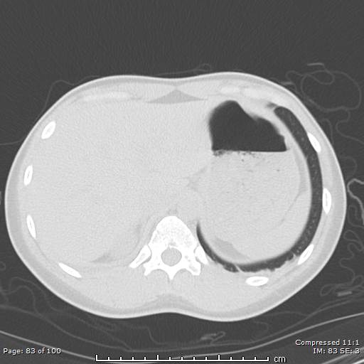Catamenial pneumothorax (Radiopaedia 54382-60600 Axial non-contrast 83).jpg
