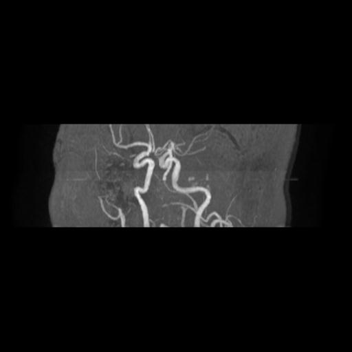 Cavernoma with developmental venous anomaly (Radiopaedia 22470-22507 MRA 5).jpg