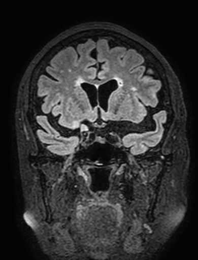 Cavernous hemangioma of the cerebellar falx (Radiopaedia 73025-83724 Coronal FLAIR 129).jpg