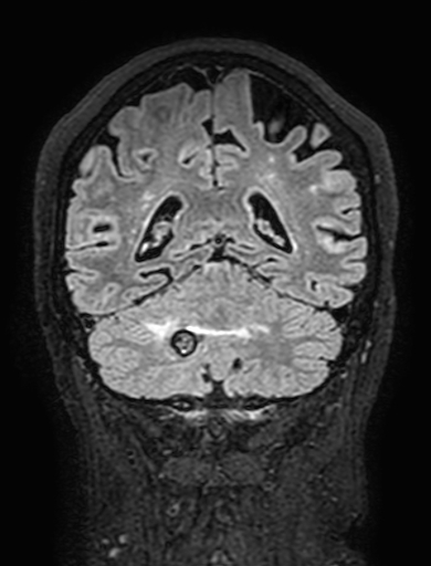 Cavernous hemangioma of the cerebellar falx (Radiopaedia 73025-83724 Coronal FLAIR 250).jpg