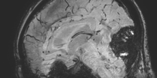 Cavernous hemangioma of the cerebellar falx (Radiopaedia 73025-83724 Sagittal BOLD 100).jpg