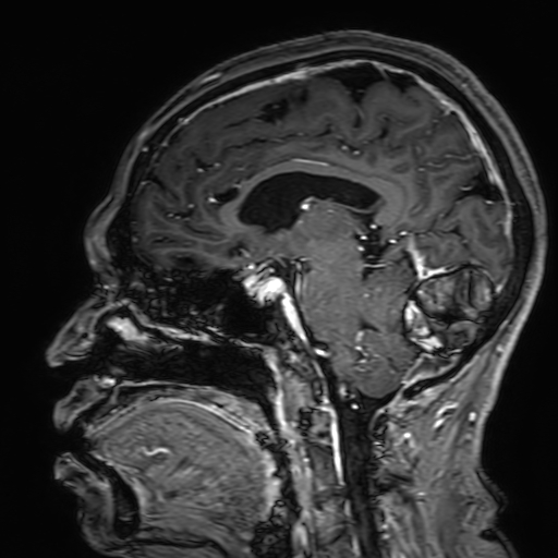 Cavernous hemangioma of the cerebellar falx (Radiopaedia 73025-83724 Sagittal T1 C+ 115).jpg