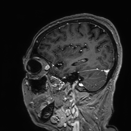 Cavernous hemangioma of the cerebellar falx (Radiopaedia 73025-83724 Sagittal T1 C+ 54).jpg