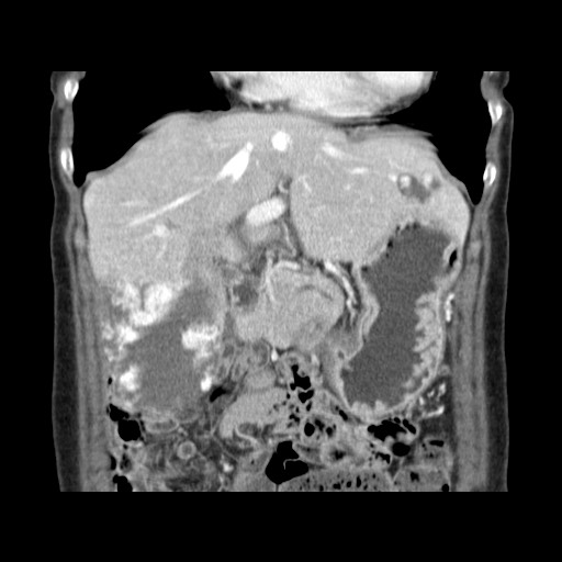 Cavernous hepatic hemangioma (Radiopaedia 75441-86667 C 48).jpg