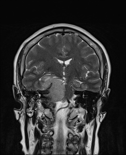 File:Cavernous sinus meningioma (Radiopaedia 63682-72367 Coronal T2 9).jpg
