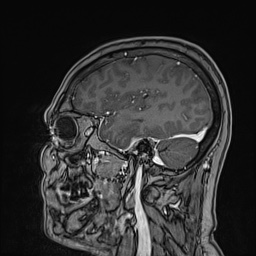 Cavernous sinus meningioma (Radiopaedia 63682-72367 Sagittal T1 C+ 55).jpg