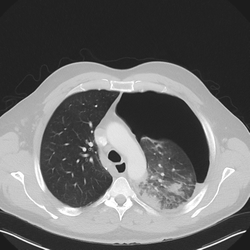 Cavitating pneumonia complicated by pneumothorax (Radiopaedia 48149-52994 Axial lung window 22).png