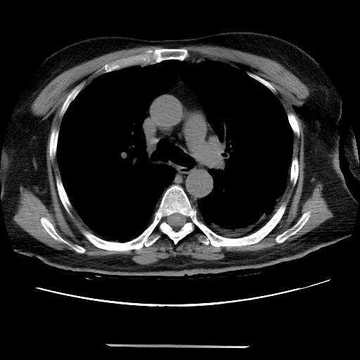 File:Cavitating pulmonary metastases (Radiopaedia 89545-106544 Axial non-contrast 23).jpg