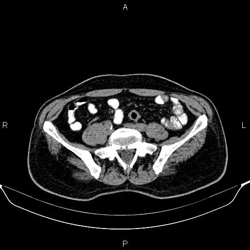 File:Cecal adenocarcinoma (Radiopaedia 85324-100916 Axial non-contrast 67).jpg
