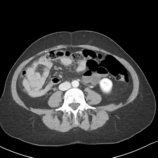 Cecal internal hernia through the foramen of Winslow (Radiopaedia 44820-48651 B 43).png