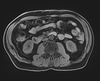Cecal mass causing appendicitis (Radiopaedia 59207-66532 Axial T1 69).jpg