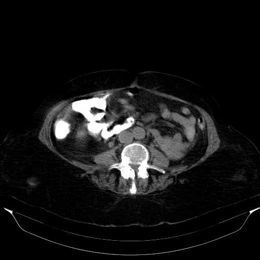 File:Cecal tumor with large pelvic lipoma (Radiopaedia 20508).jpg