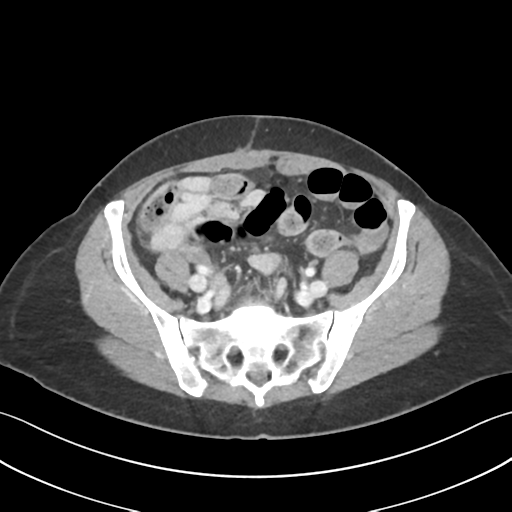 Cecum hernia through the foramen of Winslow (Radiopaedia 46634-51112 A 53).png