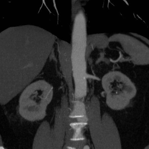 File:Celiac artery compression by the diaphragmatic crurae (Radiopaedia 31739-32666 B 8).jpg