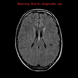 File:Central nervous system vasculitis (Radiopaedia 8410-9235 Axial FLAIR 15).jpg