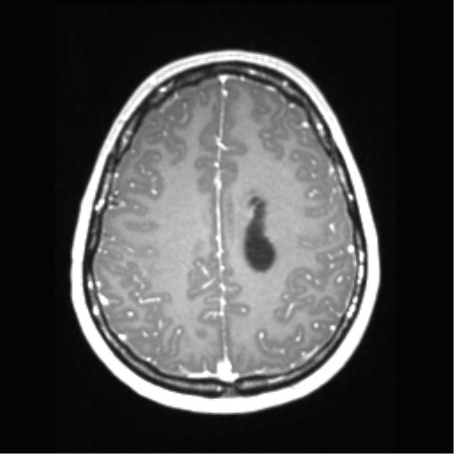 File:Central neurocytoma (Radiopaedia 37664-39557 Axial T1 C+ 59).png