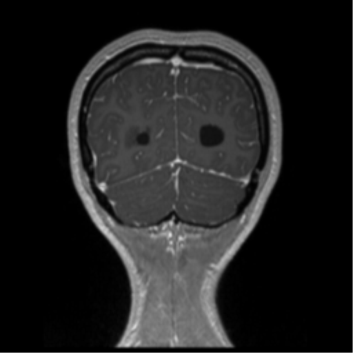 Central neurocytoma (Radiopaedia 37664-39557 Coronal T1 C+ 14).png