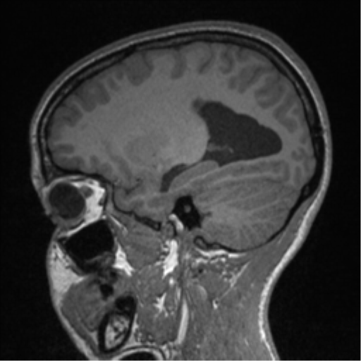 Central neurocytoma (Radiopaedia 37664-39557 Sagittal T1 32).png
