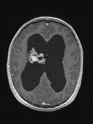 Central neurocytoma (Radiopaedia 56690-63469 Axial T1 C+ 103).jpg