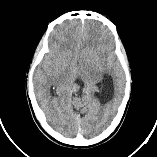 Central neurocytoma (Radiopaedia 84497-99871 Axial non-contrast 20).jpg