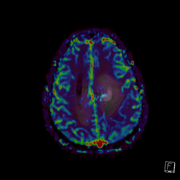 Central neurocytoma (Radiopaedia 84497-99872 Axial Perfusion 80).jpg
