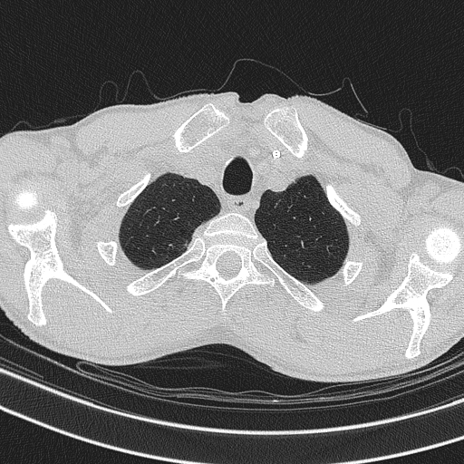 Central venous catheter tip extravasation (Radiopaedia 82828-97113 Axial lung window 14).jpg