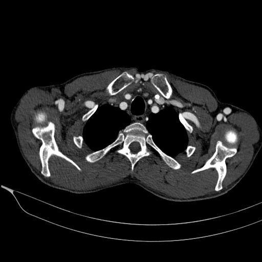 File:Central venous catheter tip extravasation (Radiopaedia 82828-97113 D 25).jpg