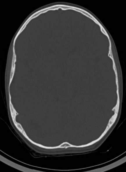 File:Cerebellar abscess (Radiopaedia 73727-84527 Axial bone window 33).jpg