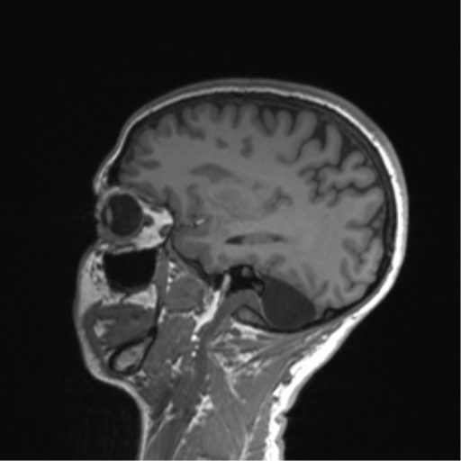 Cerebellar agenesis with hypoplastic pons (pontocerebellar hypoplasia) (Radiopaedia 57224-64138 Sagittal T1 47).png