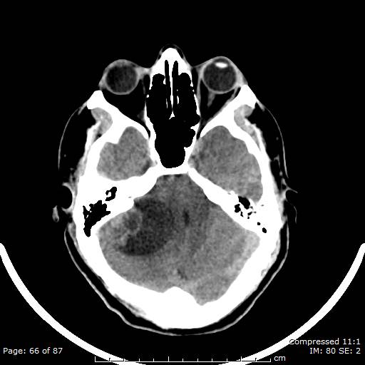 Cerebellar hemangioblastoma (Radiopaedia 52360-58258 Axial non-contrast 66).jpg