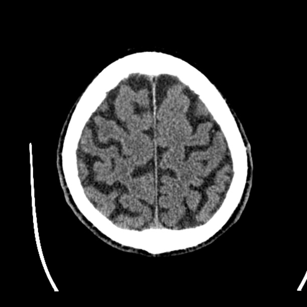 Cerebellar hemorrhage (Radiopaedia 27193-27359 Axial non-contrast 45).jpg