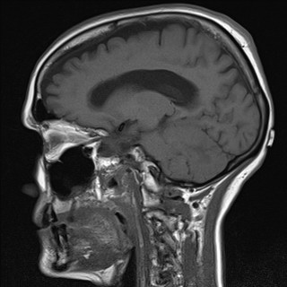 File:Cerebellar metastases (Radiopaedia 24038-24249 Sagittal T1 6).jpg