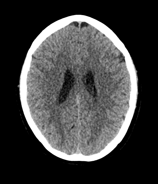 Cerebellar metastases - colorectal adenocarcinoma (Radiopaedia 40947-43652 Axial non-contrast 41).png
