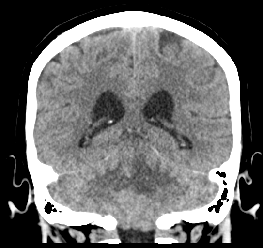 Cerebellar metastasis (Radiopaedia 54578-60812 Coronal non-contrast 38).png