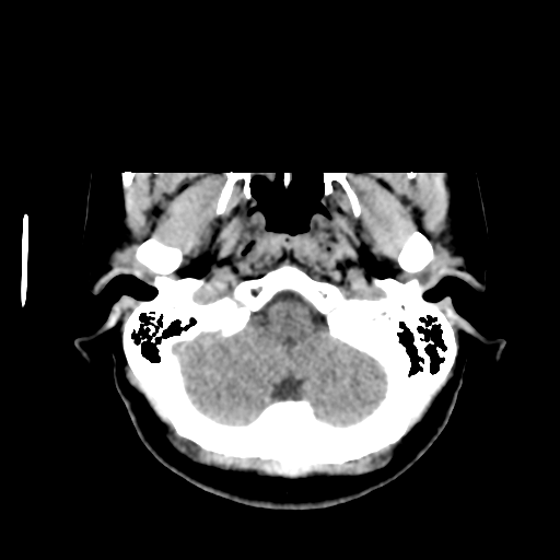 Cerebellar metastasis (cystic appearance) (Radiopaedia 41395-44258 Axial non-contrast 9).png