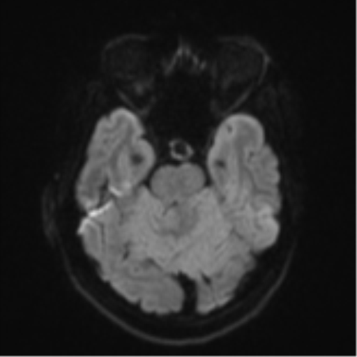 Cerebellar metastasis - adenocarcinoma lung (Radiopaedia 63184-71715 Axial DWI 38).png