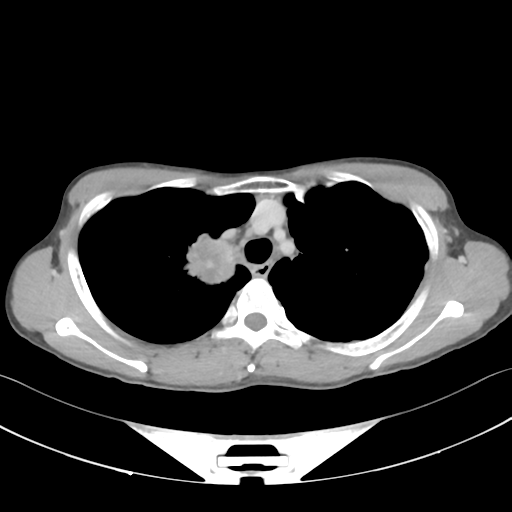 Cerebellar metastasis - adenocarcinoma lung (Radiopaedia 63184-71717 Axial C+ delayed 19).png