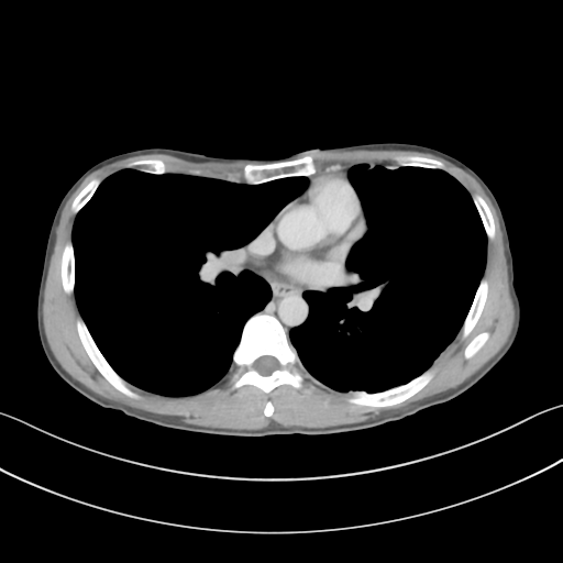File:Cerebellar metastasis - adenocarcinoma lung (Radiopaedia 63184-71717 Axial C+ delayed 35).png