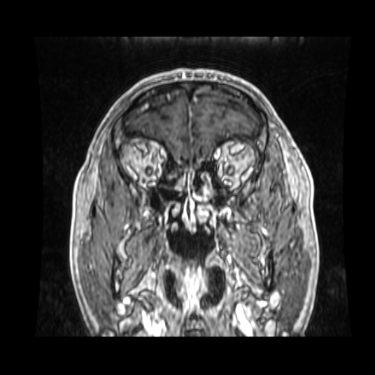 Cerebellar metastasis of pulmonary adenocarcinoma, cavernous venous malformation, and developmental venous anomaly (Radiopaedia 85827-101661 Coronal T1 C+ 77).jpg