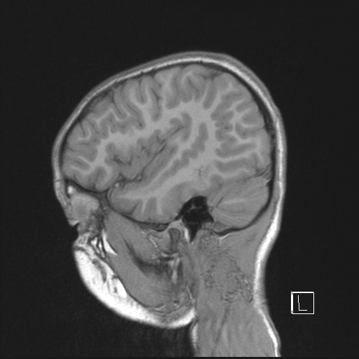 File:Cerebellar stroke (Radiopaedia 32202-33150 Sagittal T1 C+ 11).png