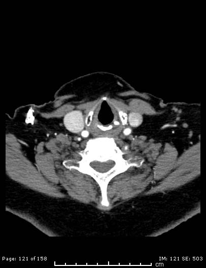 Cerebellar strokes due to intracranial giant cell arteritis (Radiopaedia 68799-78510 CT angiogram 121).jpg