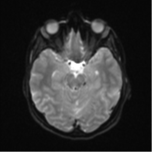 Cerebellar tuberculomas (Radiopaedia 46939-51472 Axial DWI 11).png