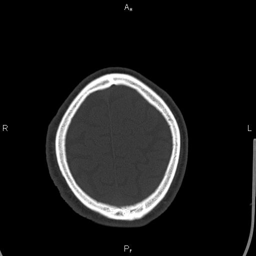 Cerebellopontine angle arachnoid cyst (Radiopaedia 85149-100704 Axial bone window 45).jpg