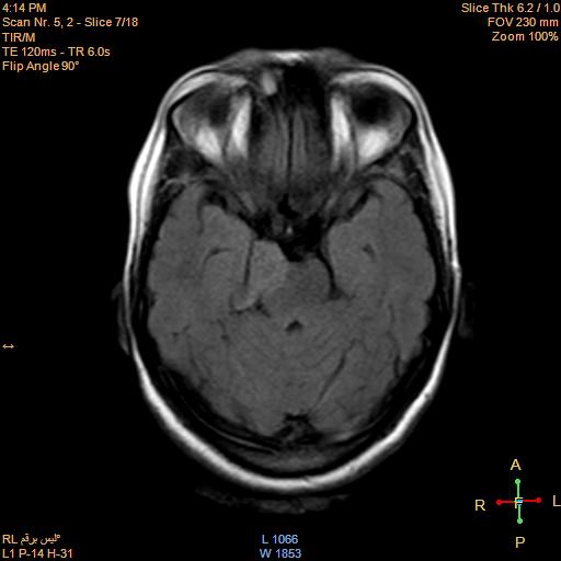 File:Cerebellopontine angle meningioma (Radiopaedia 22488-22525 Axial FLAIR 5).jpg