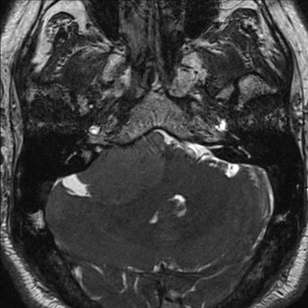Cerebellopontine angle meningioma (Radiopaedia 24459-24764 I 18).jpg