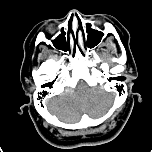 Cerebellopontine angle meningioma (Radiopaedia 35181-36714 A 40).jpg