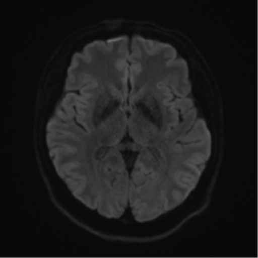 Cerebellopontine angle meningioma (Radiopaedia 48434-53348 Axial DWI 56).png