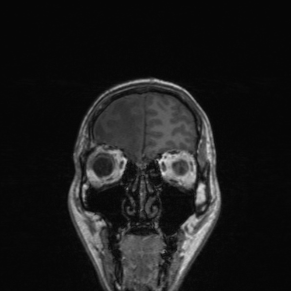 Cerebral abscess (Radiopaedia 24212-24478 Coronal T1 48).jpg