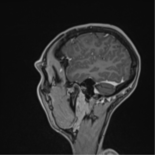 Cerebral abscess (Radiopaedia 60342-68009 J 13).png